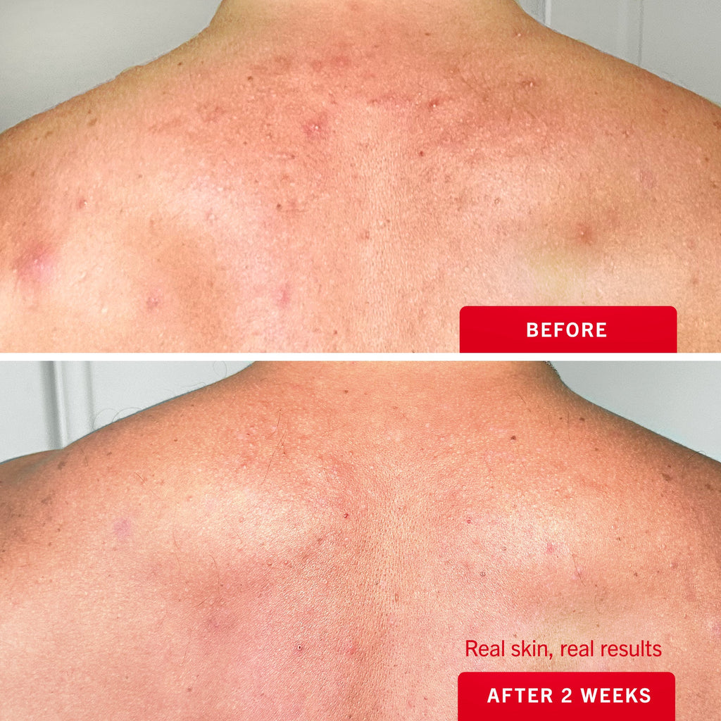 Body Acne Clearing Mist with 2% Salicylic Acid