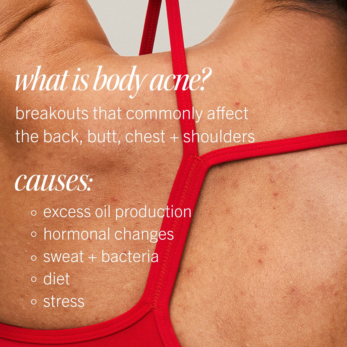 Body Acne Clearing Mist with 2% Salicylic Acid